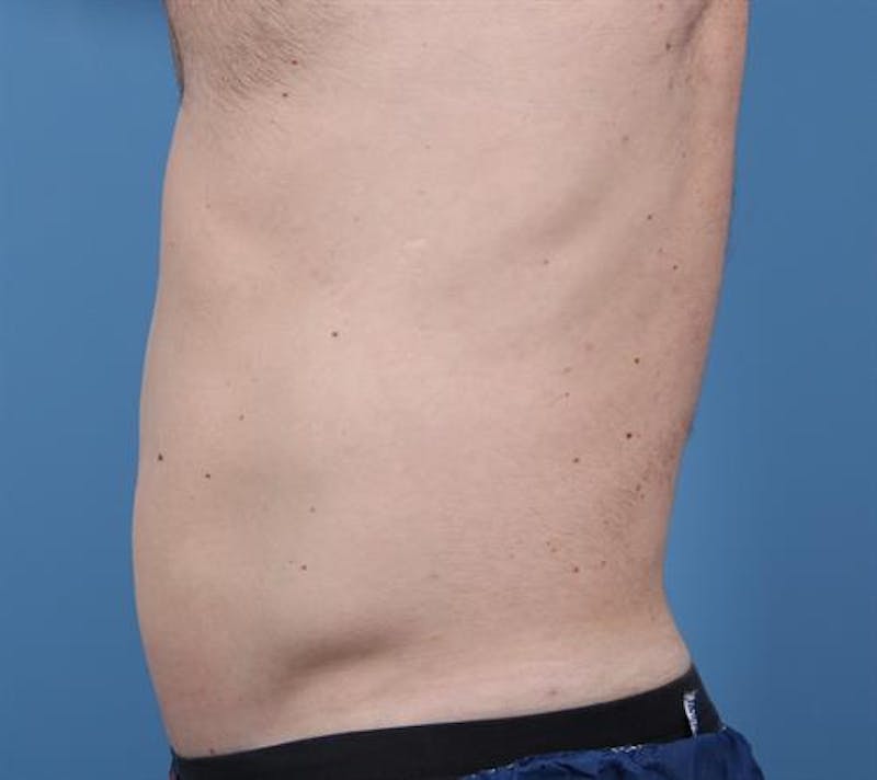 CoolSculpting Before & After Gallery - Patient 130045 - Image 4