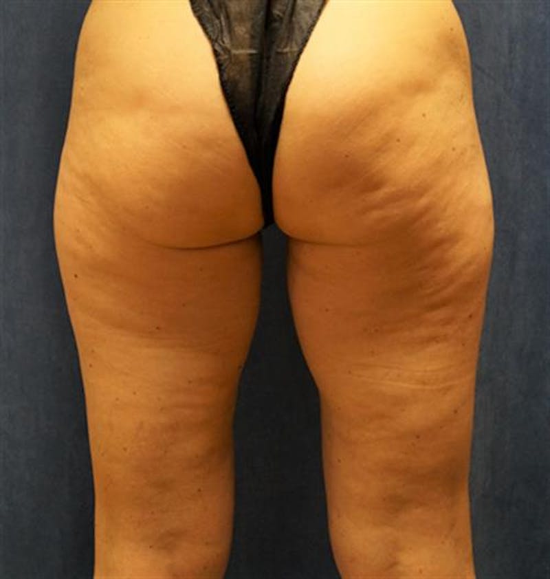 CoolSculpting Before & After Gallery - Patient 269320 - Image 1