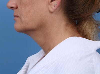 CoolSculpting Before & After Gallery - Patient 255505 - Image 1