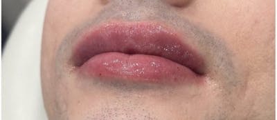 Dermal Fillers Before & After Gallery - Patient 113807 - Image 2