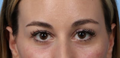 Dermal Fillers Before & After Gallery - Patient 217025 - Image 1