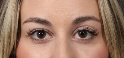 Dermal Fillers Before & After Gallery - Patient 217025 - Image 2