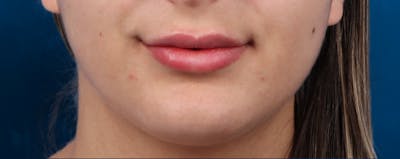 Dermal Fillers Before & After Gallery - Patient 265179 - Image 2