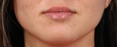 Dermal Fillers Before & After Gallery - Patient 264934 - Image 1