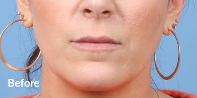 Dermal Fillers Before & After Gallery - Patient 383613 - Image 1
