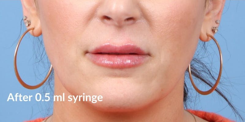 Dermal Fillers Before & After Gallery - Patient 383613 - Image 2