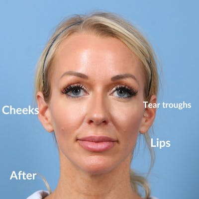 Dermal Fillers Before & After Gallery - Patient 415143 - Image 2