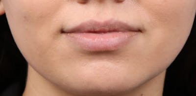 Dermal Fillers Before & After Gallery - Patient 374843 - Image 1