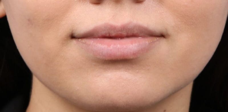 Dermal Fillers Before & After Gallery - Patient 374843 - Image 1