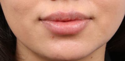 Dermal Fillers Before & After Gallery - Patient 374843 - Image 2