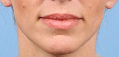 Dermal Fillers Before & After Gallery - Patient 349988 - Image 1