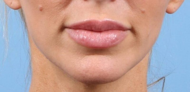 Dermal Fillers Before & After Gallery - Patient 349988 - Image 2