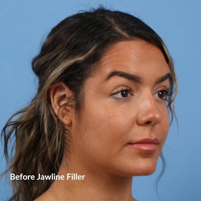 Dermal Fillers Before & After Gallery - Patient 264473 - Image 1