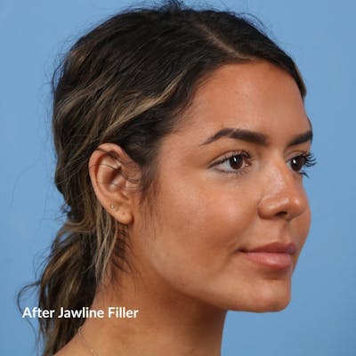 Dermal Fillers Before & After Gallery - Patient 264473 - Image 2