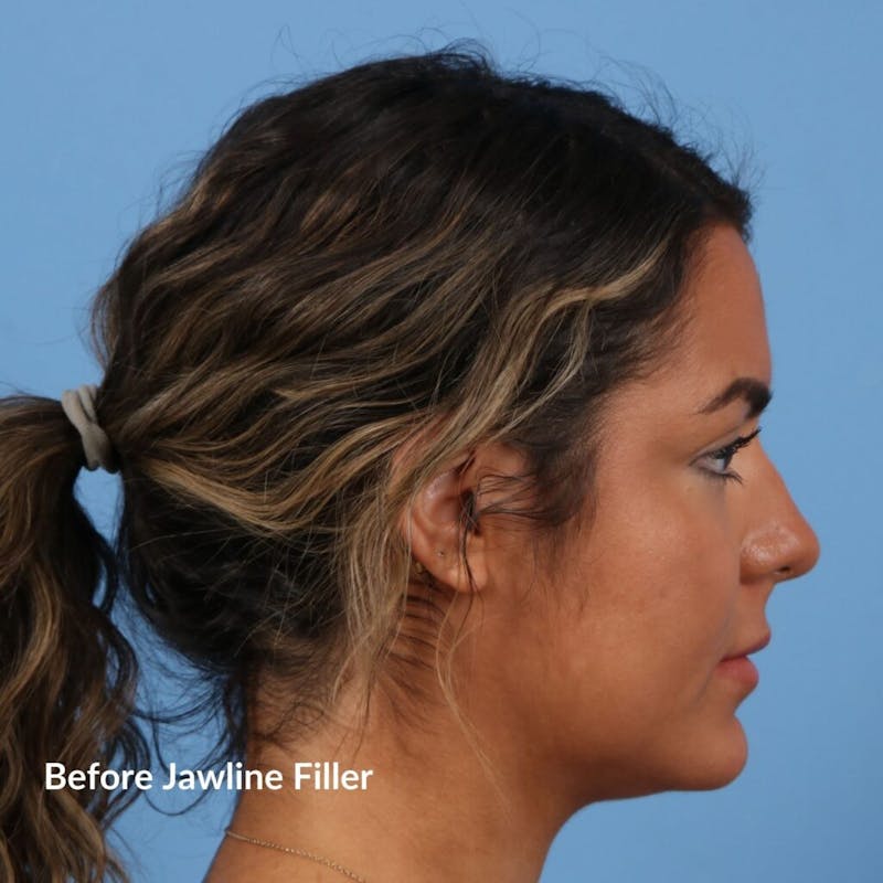 Dermal Fillers Before & After Gallery - Patient 264473 - Image 3
