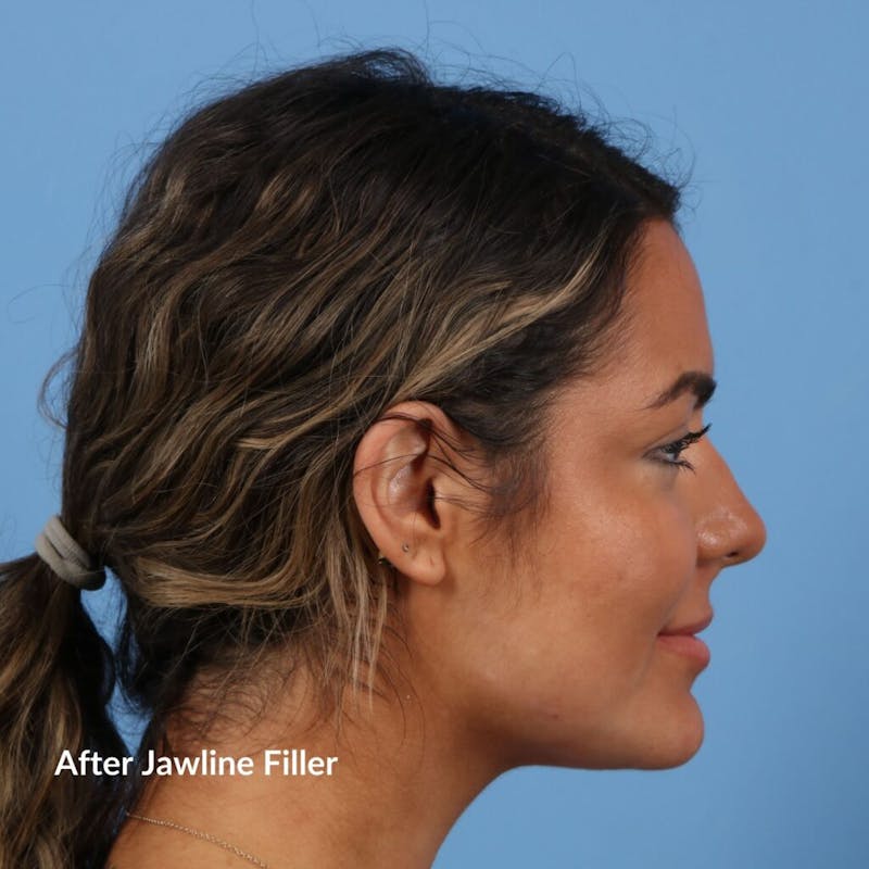 Dermal Fillers Before & After Gallery - Patient 264473 - Image 4