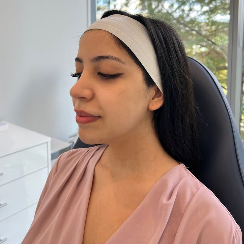 Dermal Fillers Before & After Gallery - Patient 316819 - Image 1