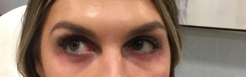 Dermal Fillers Before & After Gallery - Patient 283413 - Image 1