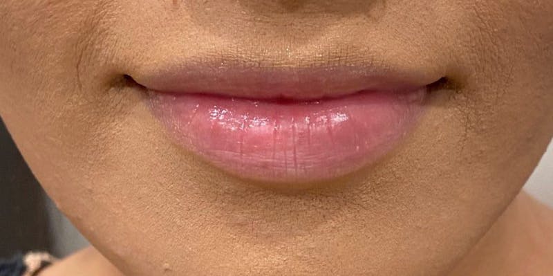 Dermal Fillers Before & After Gallery - Patient 209286 - Image 1