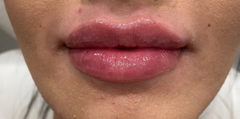 Dermal Fillers Before & After Gallery - Patient 209286 - Image 2