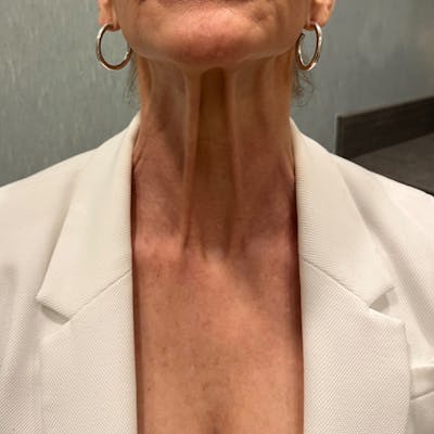 BOTOX Before & After Gallery - Patient 217532 - Image 1