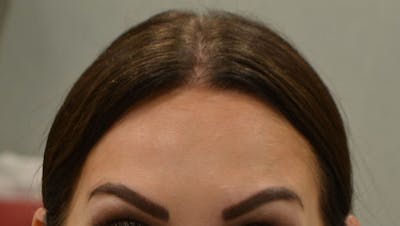 BOTOX Before & After Gallery - Patient 189229 - Image 2