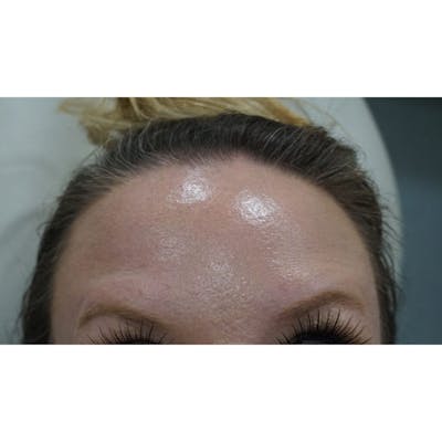 BOTOX Before & After Gallery - Patient 674046 - Image 2