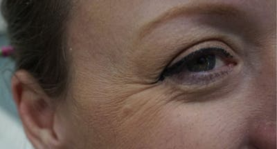 BOTOX Before & After Gallery - Patient 166233 - Image 1