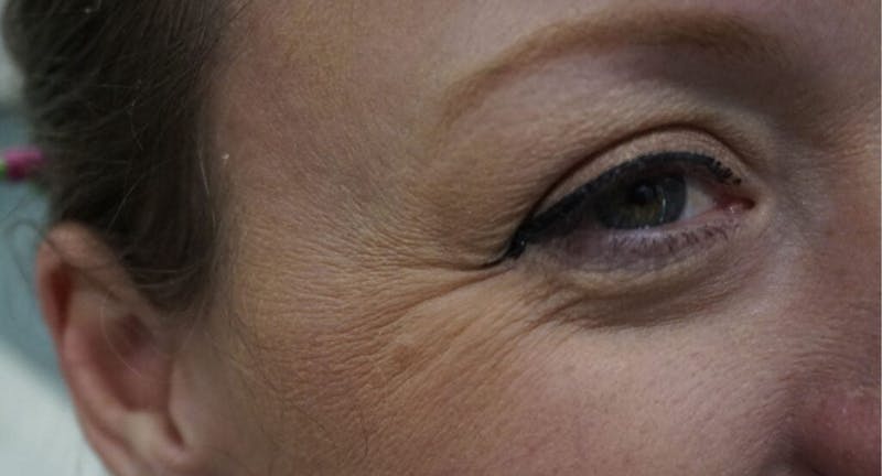 BOTOX Before & After Gallery - Patient 166233 - Image 1