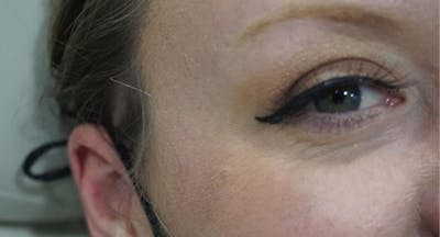 BOTOX Before & After Gallery - Patient 166233 - Image 2