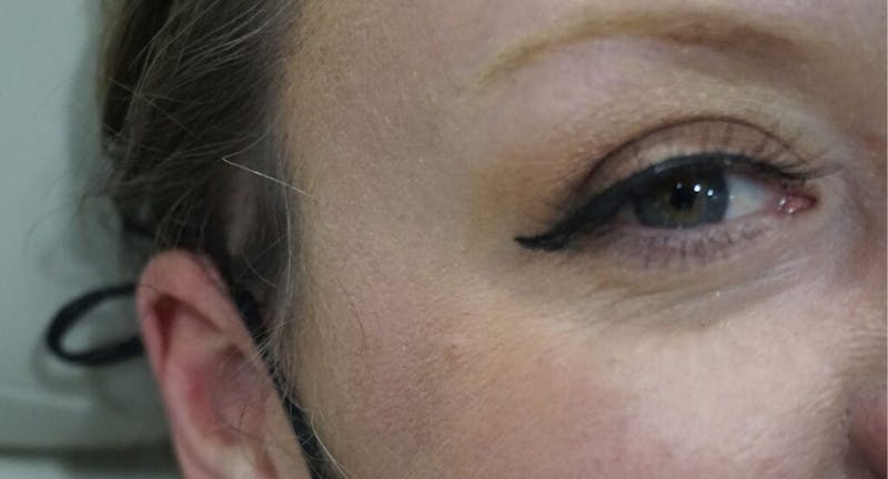 BOTOX Before & After Gallery - Patient 166233 - Image 2