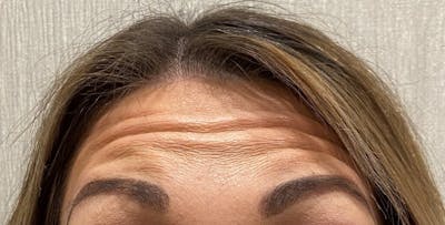 BOTOX Before & After Gallery - Patient 811977 - Image 1