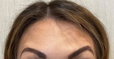 BOTOX Before & After Gallery - Patient 811977 - Image 2