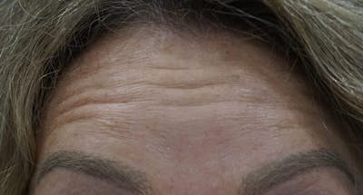BOTOX Before & After Gallery - Patient 308217 - Image 1