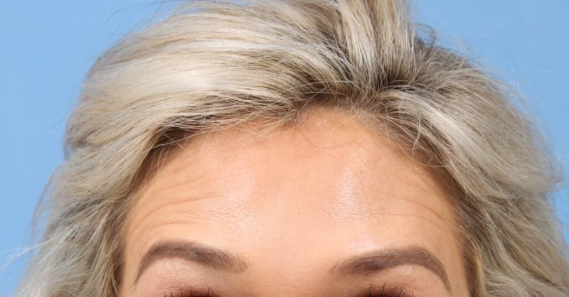 BOTOX Before & After Gallery - Patient 307594 - Image 2
