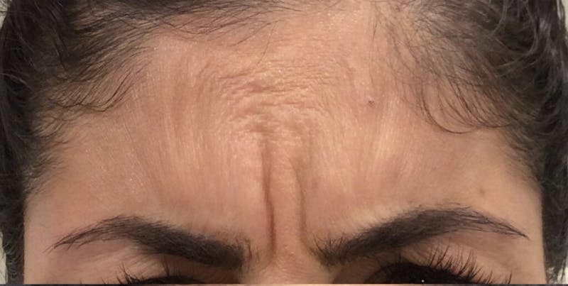 BOTOX Before & After Gallery - Patient 322157 - Image 1