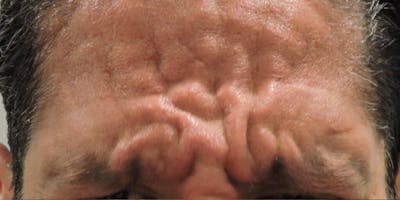 BOTOX Before & After Gallery - Patient 401234 - Image 1