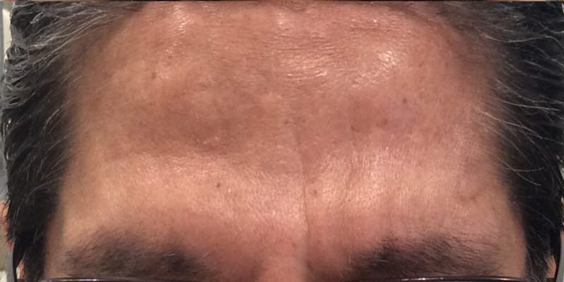 BOTOX Before & After Gallery - Patient 401234 - Image 2