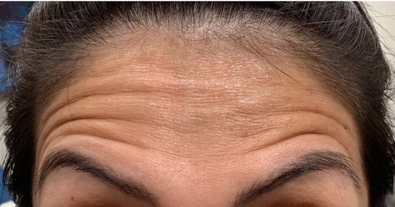 BOTOX Before & After Gallery - Patient 180542 - Image 1