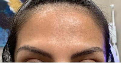 BOTOX Before & After Gallery - Patient 180542 - Image 2