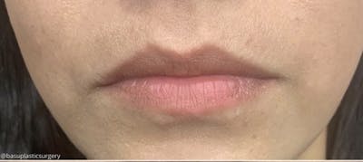 Lip Augmentation Before & After Gallery - Patient 208614 - Image 1