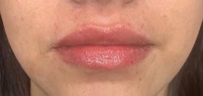 Lip Augmentation Before & After Gallery - Patient 208614 - Image 2