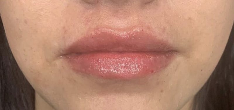 Lip Augmentation Before & After Gallery - Patient 208614 - Image 2