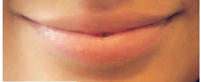 Lip Augmentation Before & After Gallery - Patient 659101 - Image 1
