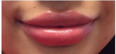 Lip Augmentation Before & After Gallery - Patient 659101 - Image 2