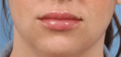 Lip Augmentation Before & After Gallery - Patient 117747 - Image 2