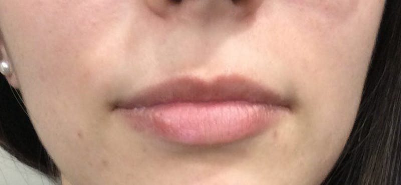 Lip Augmentation Before & After Gallery - Patient 322065 - Image 1