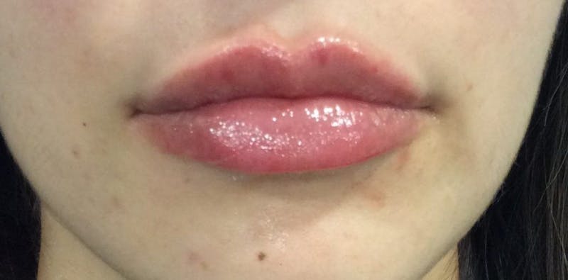 Lip Augmentation Before & After Gallery - Patient 322065 - Image 2