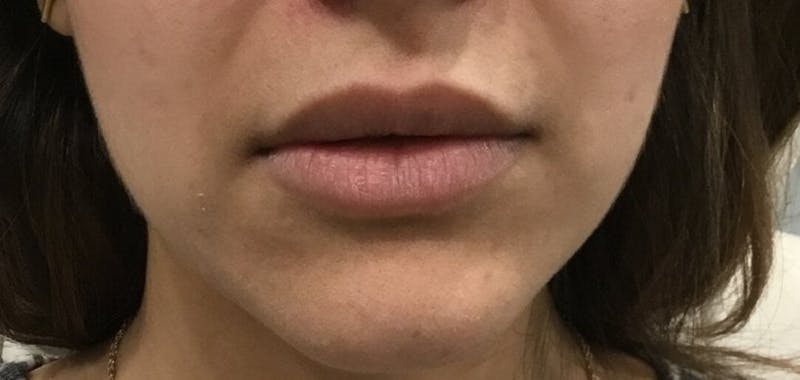 Lip Augmentation Before & After Gallery - Patient 119481 - Image 1