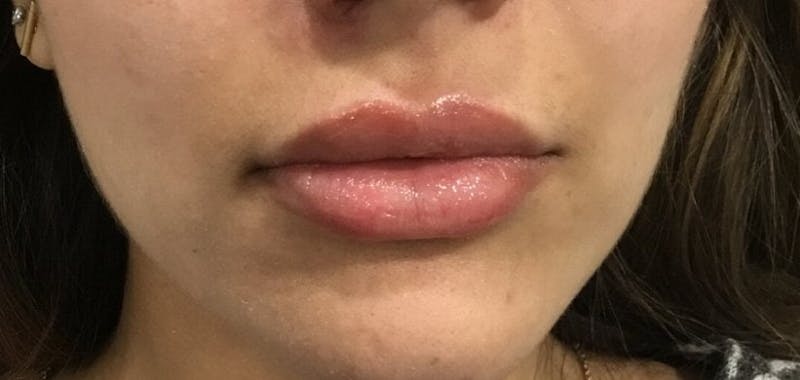 Lip Augmentation Before & After Gallery - Patient 119481 - Image 2